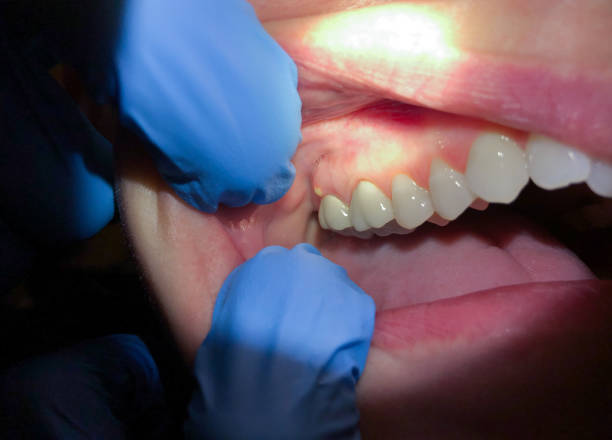 Best Emergency Treatment for Toothache in Carter Lake, IA